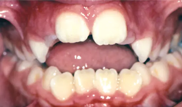 Open Bite - Why See an Orthodontist