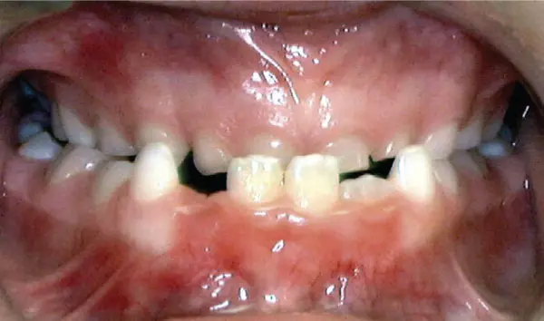 Underbite - Why See an Orthdoontist