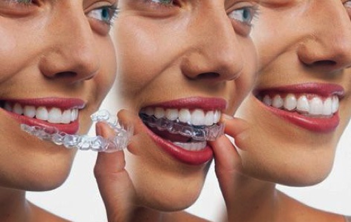 Invisalign Aligners Everything You Need To Know