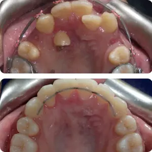 impacted tooth treatment toronto