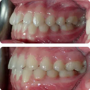 toronto invisalign for crooked teeth