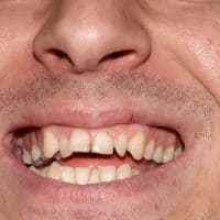 Close up of an adult male with crooked teeth