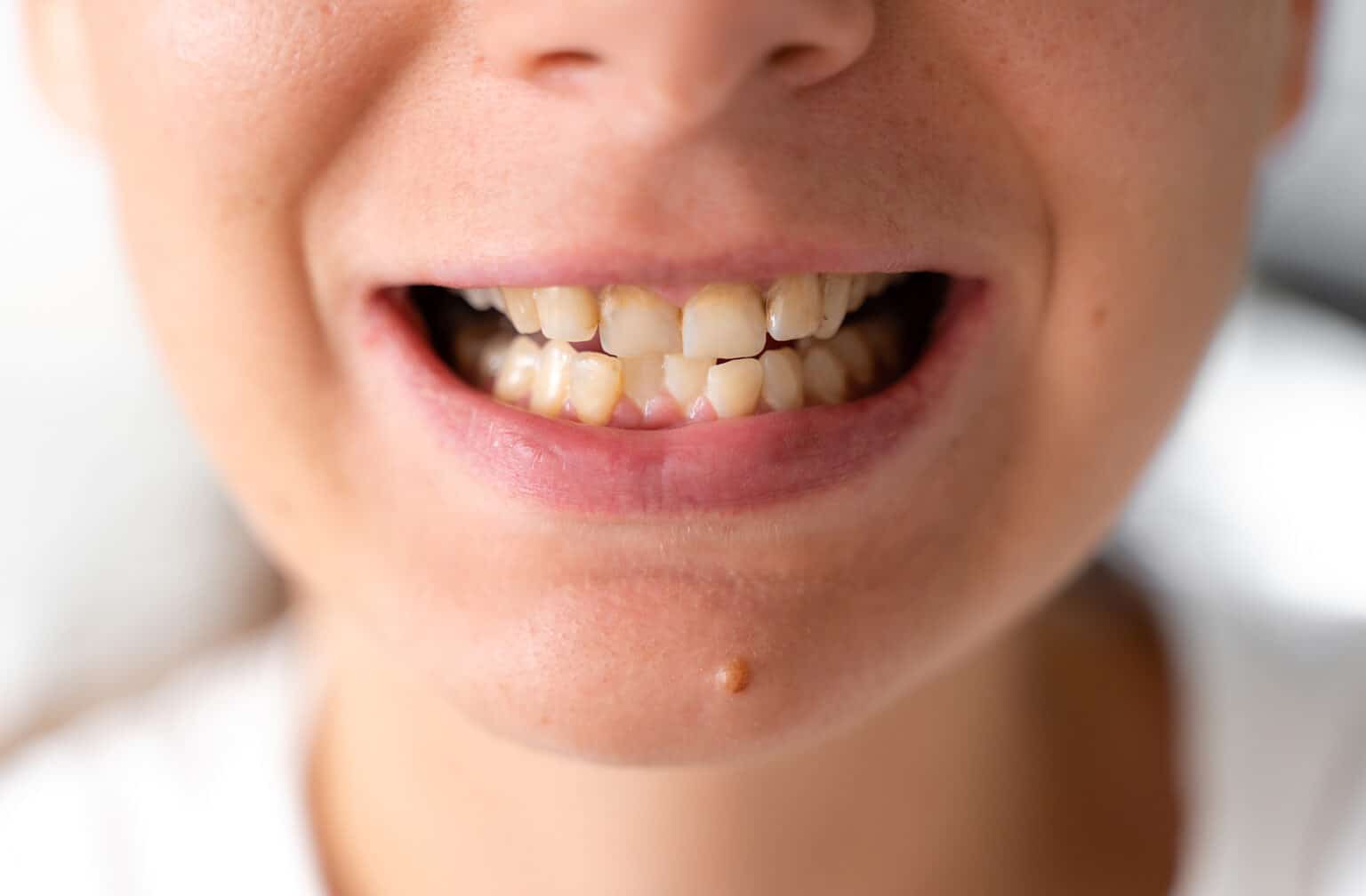 Average Cost Of Braces For Children A Comprehensive Guide