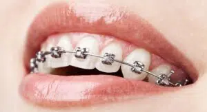 Reasons To Get Braces