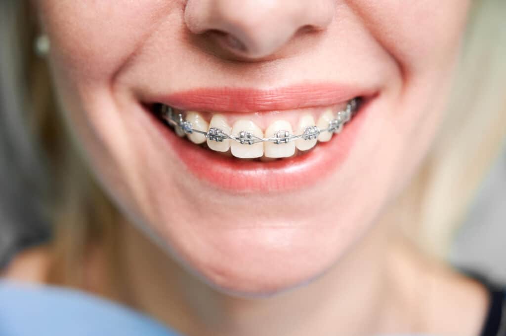 When Can I Get Adult Braces? Wired Orthodontics