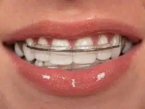 how to clean a retainer