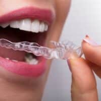 Foods To Avoid With Invisalign