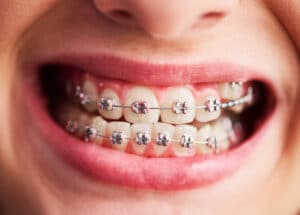 braces for child