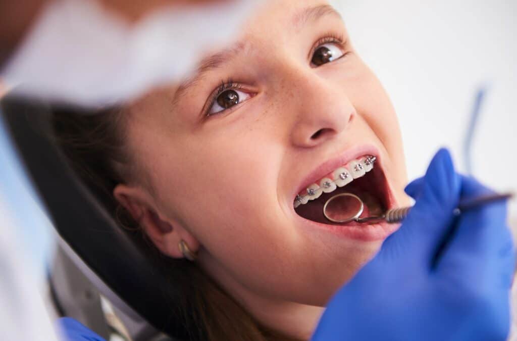 Average Cost Of Braces For Children A Comprehensive Guide
