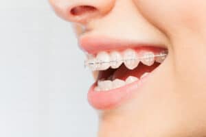 Clear Aligners vs Braces Orthodontic Options