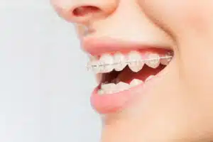 Clear Aligners vs Braces Orthodontic Options