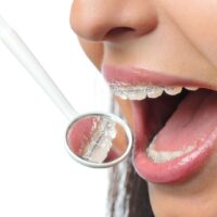 Clear Braces Toronto Comparison Guide