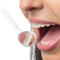 Clear Braces Toronto Comparison Guide