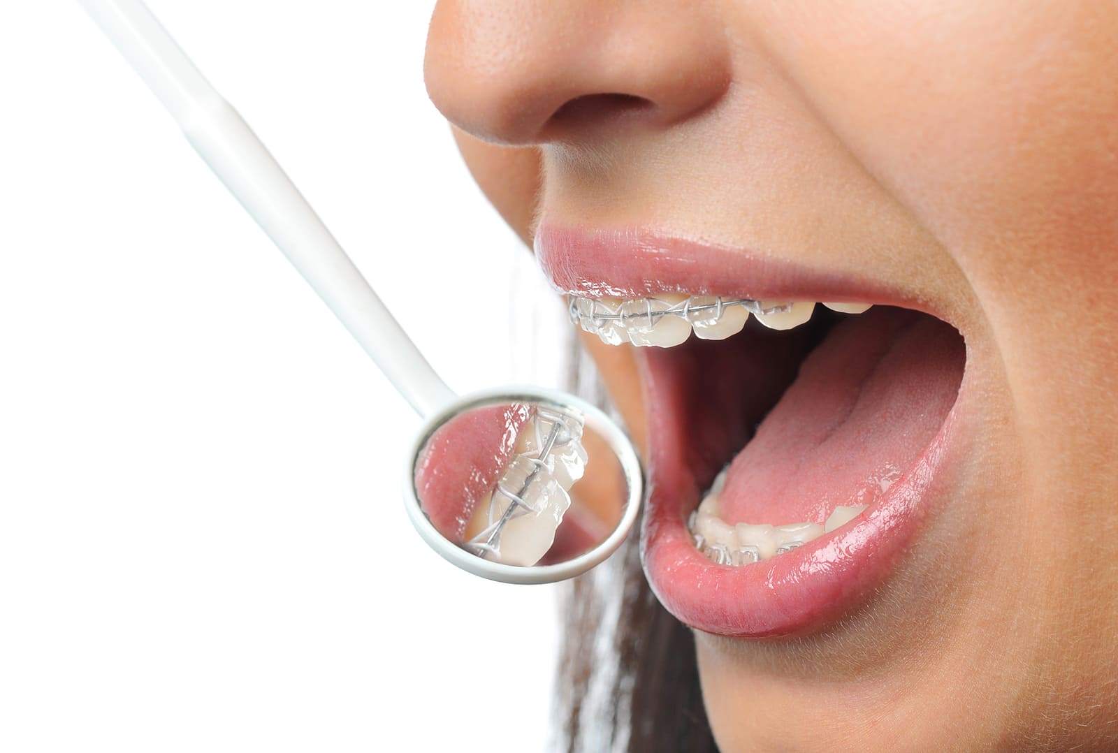 Clear Braces Toronto Comparison Guide