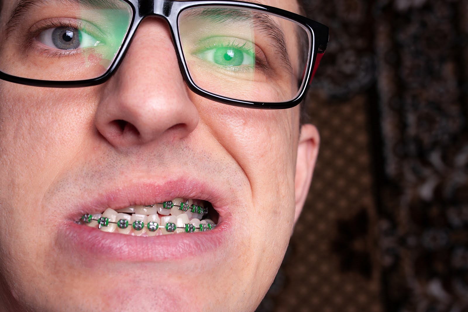 Preventing Orthodontic Emergencies Toronto