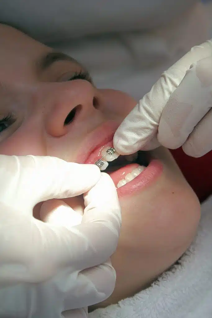 Orthodontist placing brackets on a patient’s teeth as part of the braces fitting process