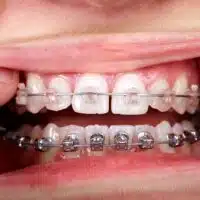 Close-up of teeth with clear and metal braces during getting braces put on