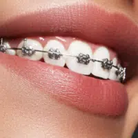 Close-up of metal braces on teeth showing proper care for braces and clean brackets