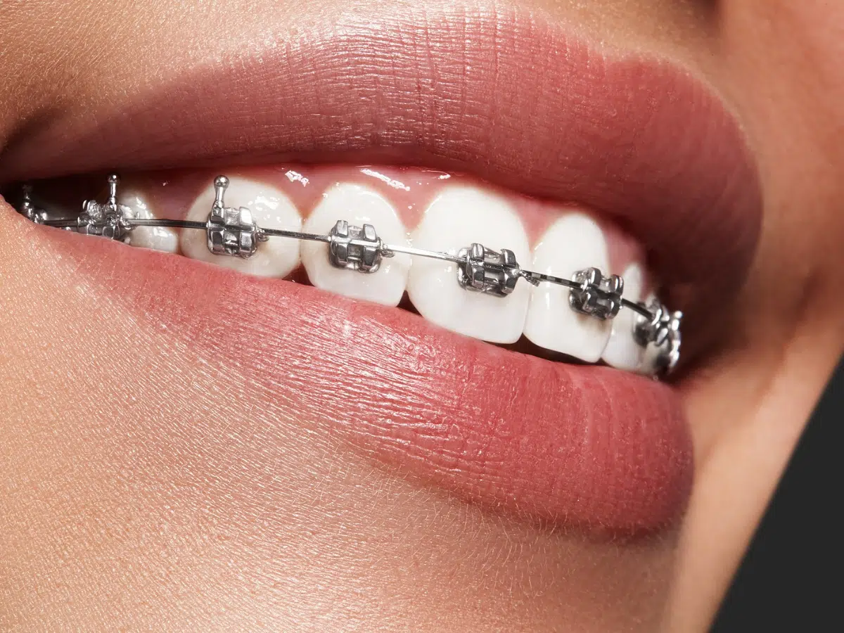 Close-up of metal braces on teeth showing proper care for braces and clean brackets