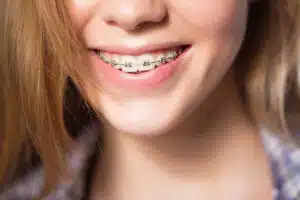Close-up of metal braces on teeth showing results of monthly braces adjustments