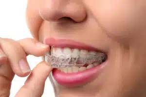Woman wearing Invisalign attachments