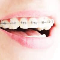 Extreme close-up of a wide smile showing clean white teeth with ceramic orthodontic braces