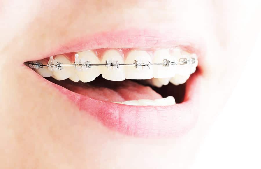 Extreme close-up of a wide smile showing clean white teeth with ceramic orthodontic braces