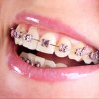 Close-up of teeth with metal braces and pink bands
