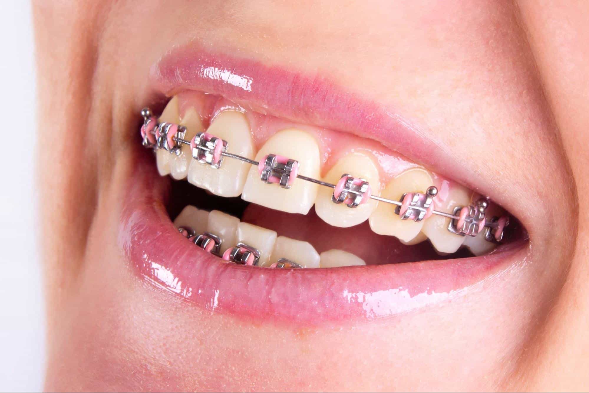 Close-up of teeth with metal braces and pink bands