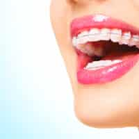 Close-up of ceramic braces on a woman's smile