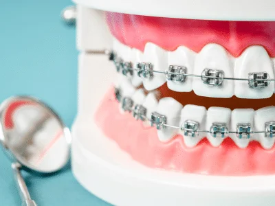 getting invisalign braces