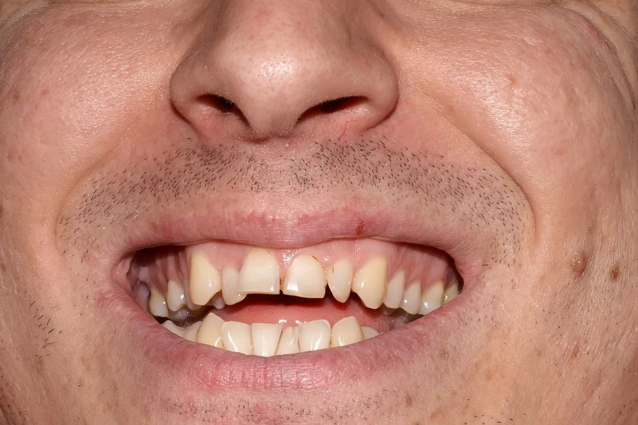 Close up of an adult male with crooked teeth