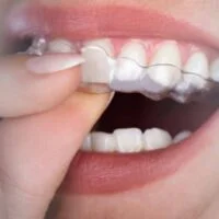 How Long Does Invisalign Take