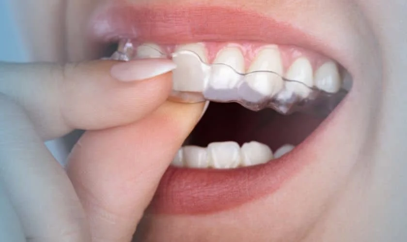 How Long Does Invisalign Take