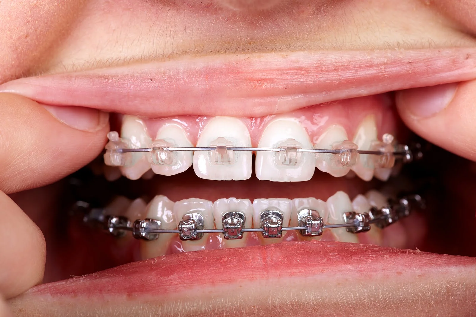 Close-up of teeth with clear and metal braces during getting braces put on